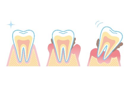 歯周病とはどんな病気なのですか?