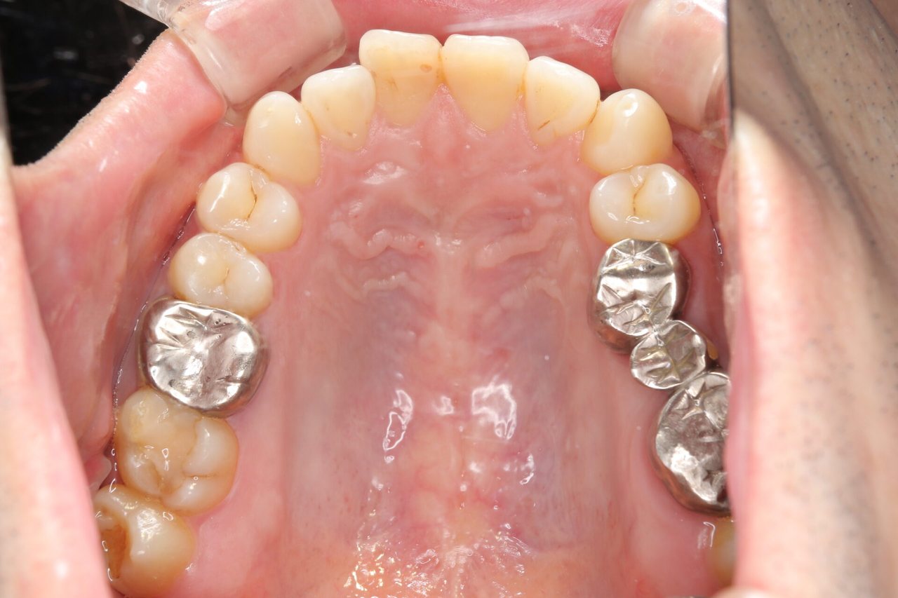 治療前