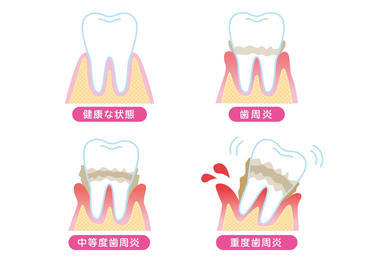 歯周病の進行段階